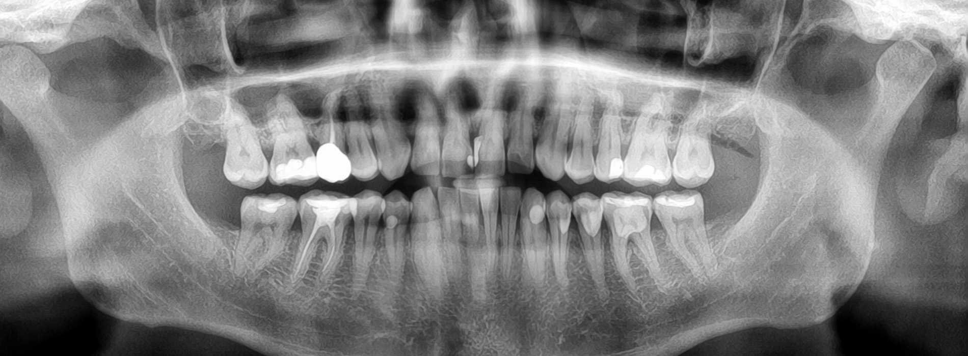 An X-ray image with a focus on a person s teeth, showcasing the upper and lower dentition against a white background.